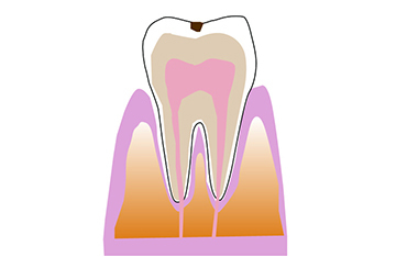 C1エナメル質の虫歯