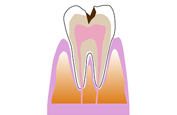 C2象牙質の虫歯